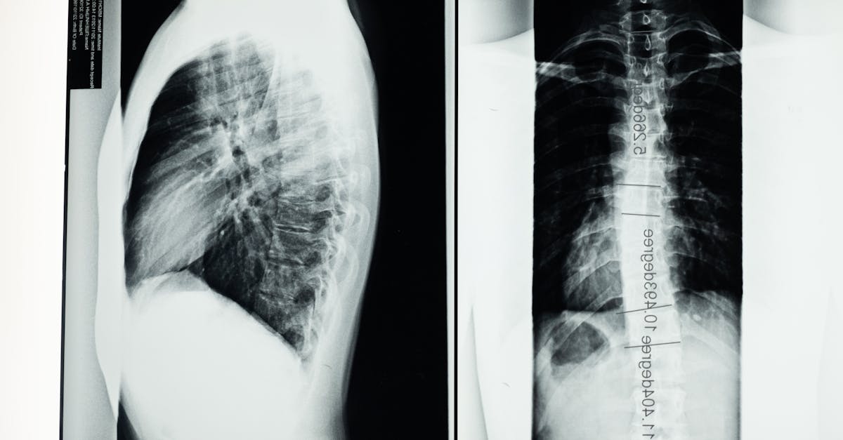 découvrez des informations essentielles sur la scoliose, ses symptômes, ses causes et les options de traitement. découvrez comment un diagnostic précoce peut conduire à une meilleure prise en charge de cette maladie de la colonne vertébrale et trouvez des ressources précieuses pour le soutien et les soins.