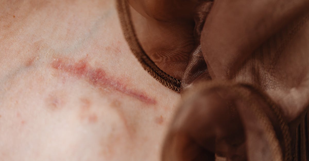 explore the causes, symptoms, and treatment options for brachial plexus injuries. understand how this condition affects the nervous system and learn about rehabilitation strategies for recovery.