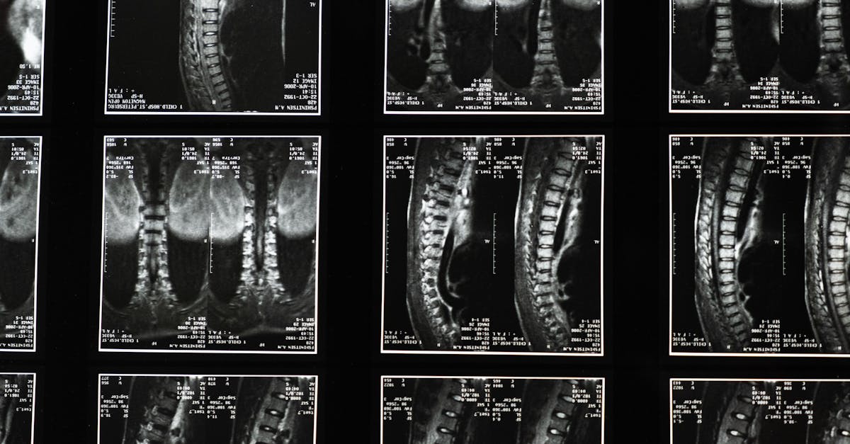 discover essential insights about scoliosis, including its causes, symptoms, and treatment options. learn how to manage this spinal condition effectively for a healthier life.