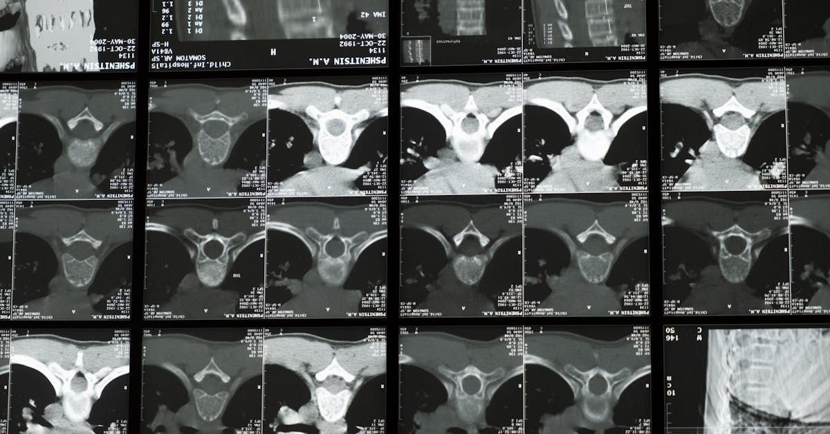 discover everything you need to know about scoliosis, including causes, symptoms, treatment options, and management strategies. learn how this condition affects the spine and gain insights from medical professionals.