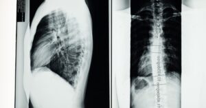 discover the causes, symptoms, and treatments of scoliosis. learn about this common spinal condition affecting millions worldwide, including its impact on health and lifestyle.